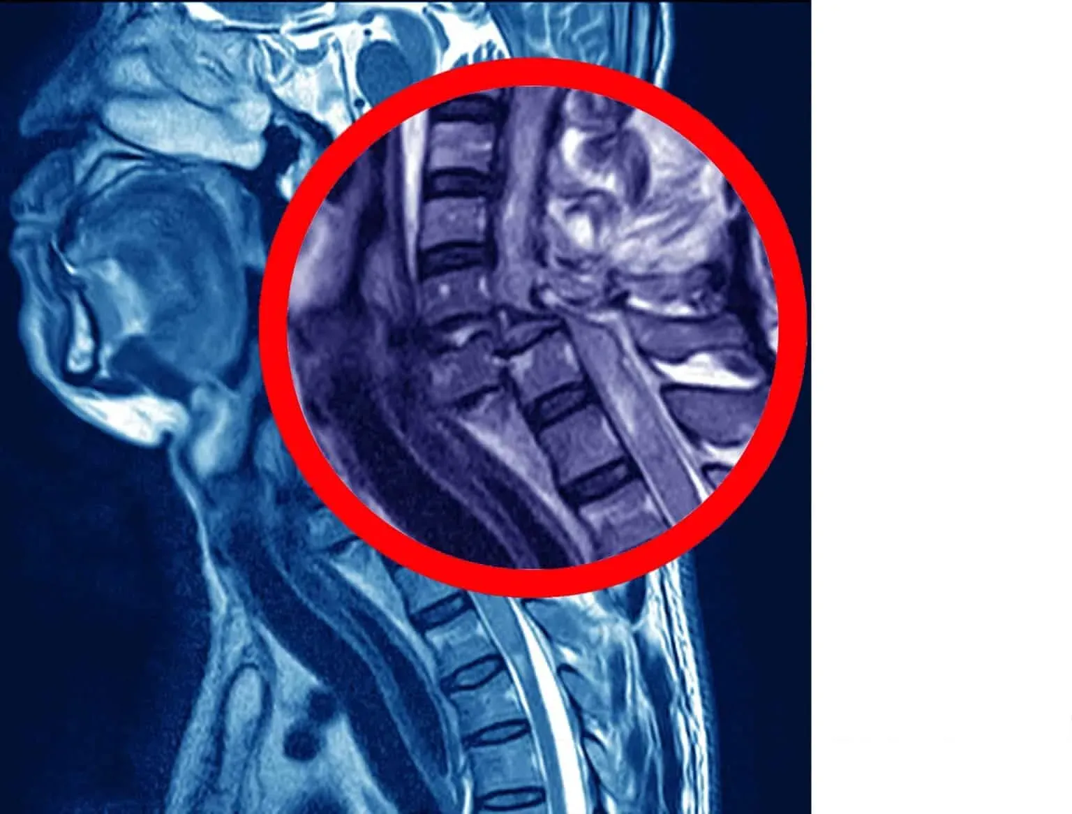 bigstock-Mri-Of-Cervical-Spine-History-338453197-min-1536x1166.webp