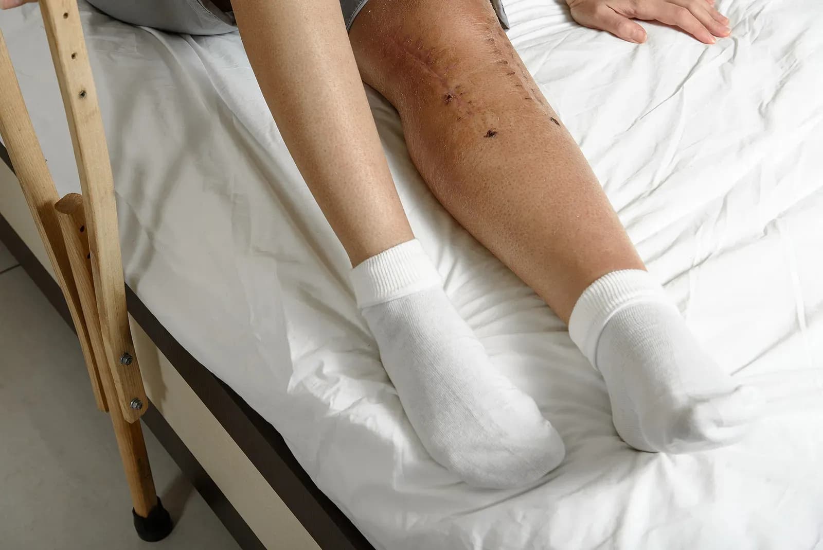 Female patient with postoperative suture after surgery on broken