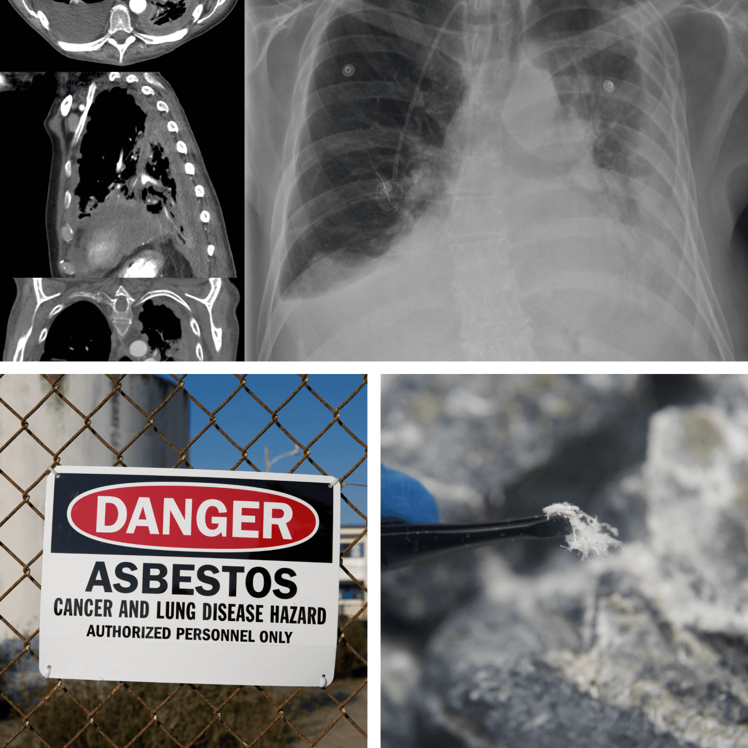 Mesothelioma-and-Asbestos