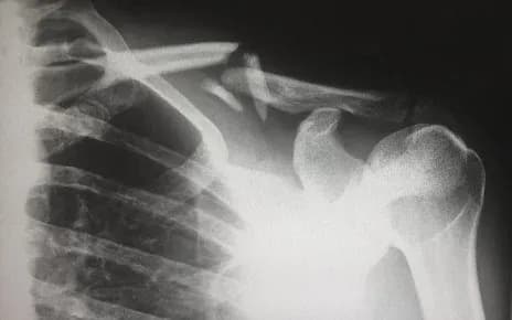 fractured bone from a personal injury